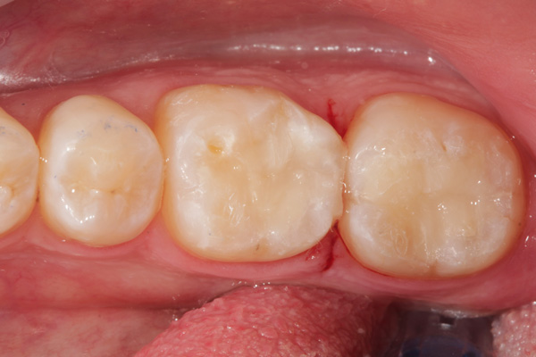 composite filling case after 2