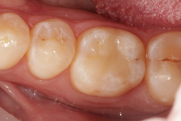 composite filling case after 3