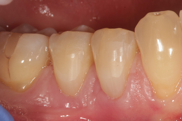 composite filling case after 4