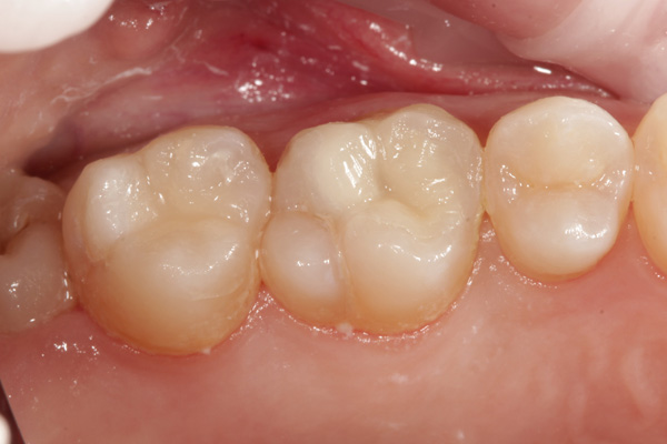 composite filling case after 5