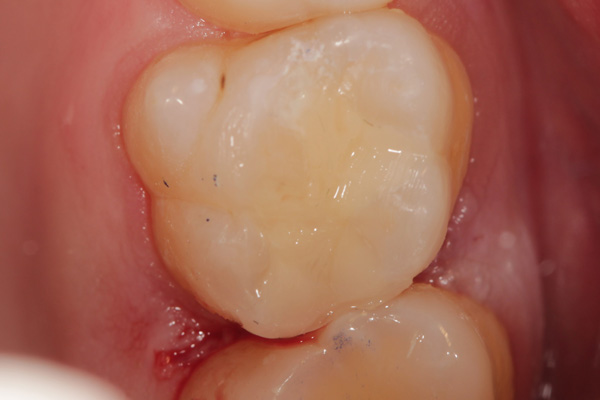 composite filling case after 6