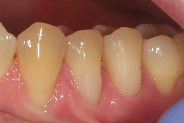 composite filling case after 7