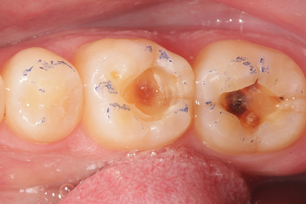 composite filling case before 2