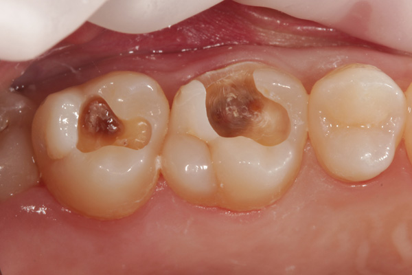 composite filling case before 5