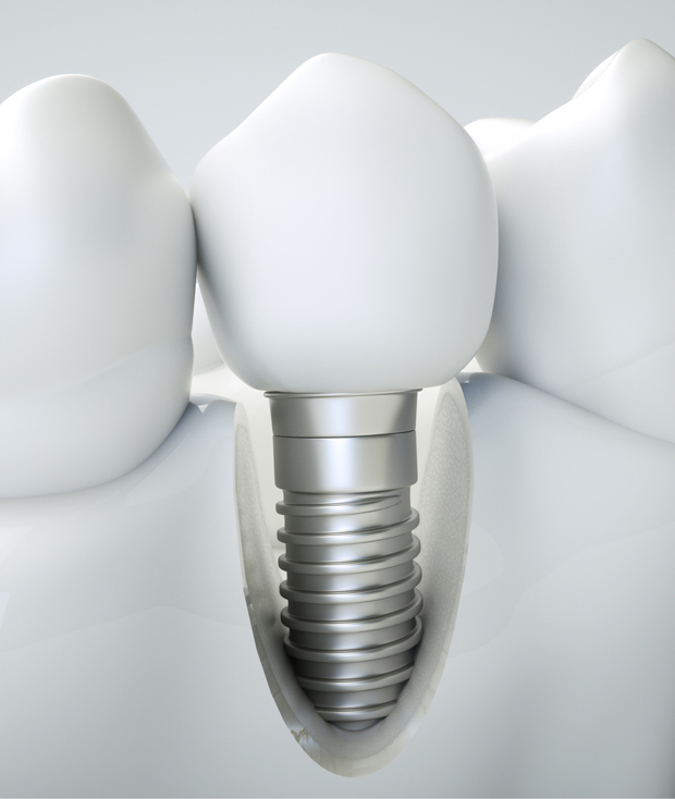 Dental Implants can help...