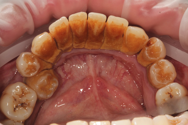 hygienist case before 2