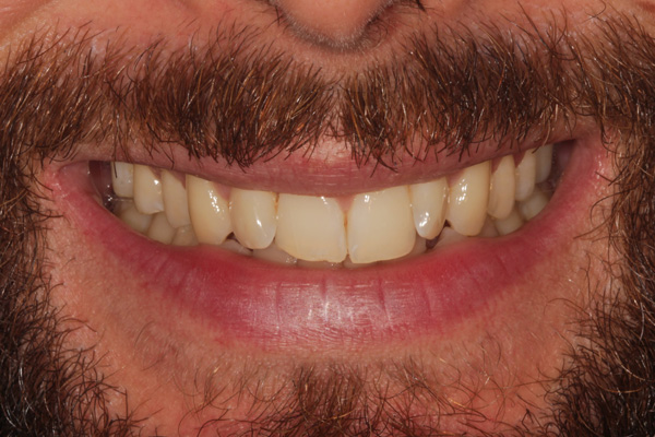 invisalign case before 1