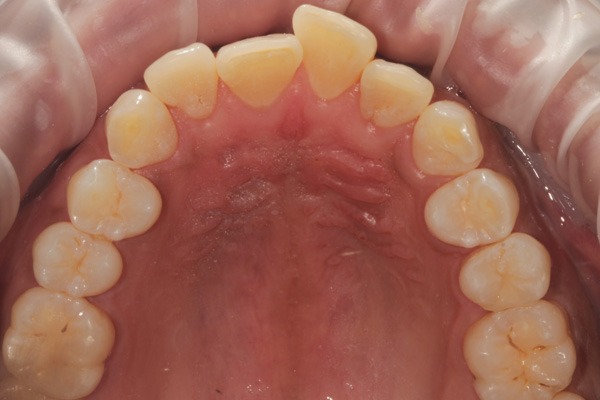 invisalign case before 2