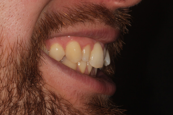 invisalign case before 3