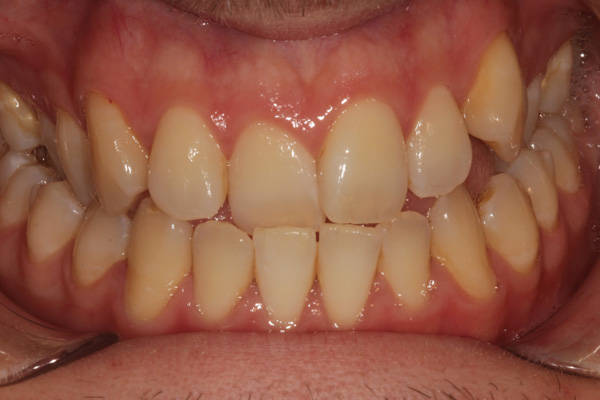 invisalign case before 4