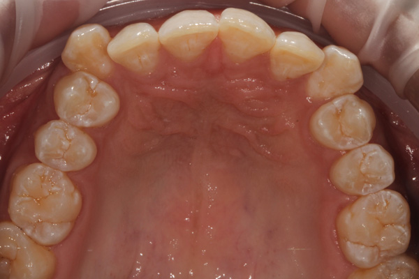 invisalign case before 6