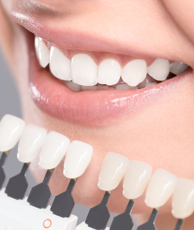 What are porcelain veneers?