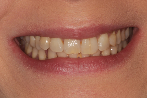 whitening case before 1