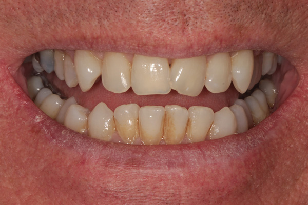 whitening case before 3