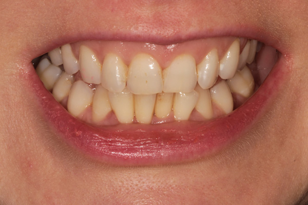 whitening case before 4