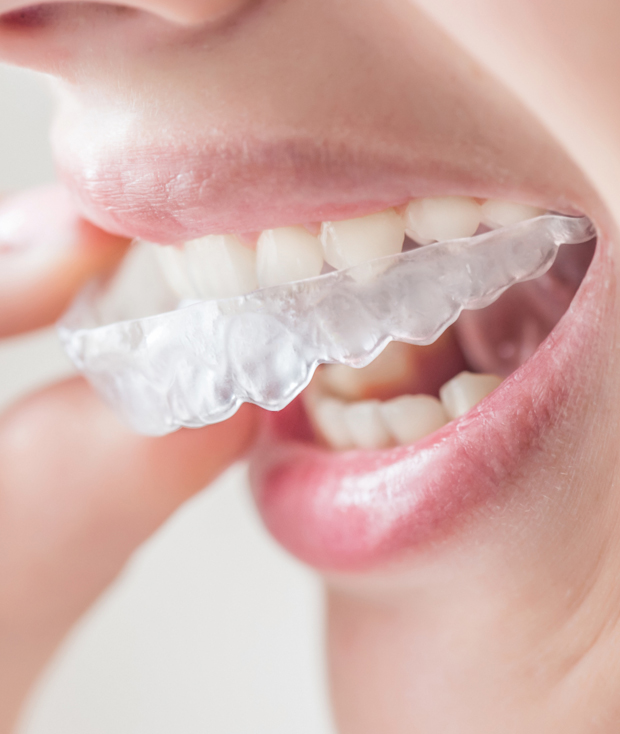 What Is Invisalign?